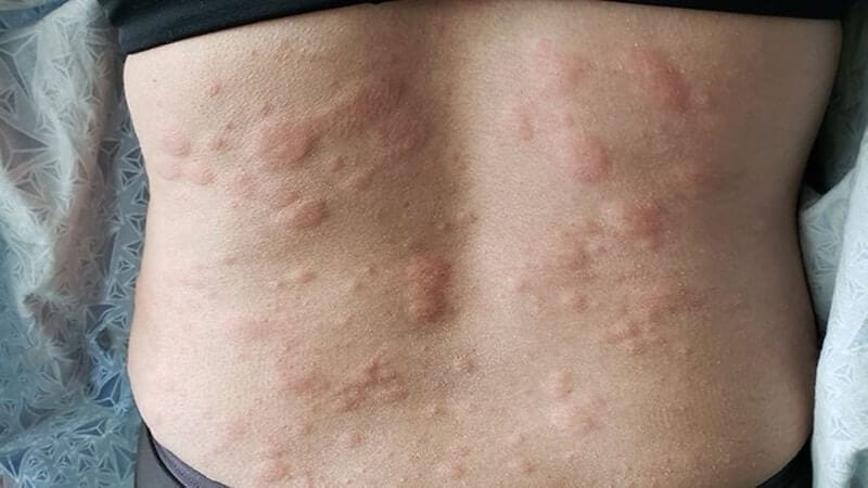 Understanding Where You Typically Itch With Liver Problems – Itching | , Understanding
