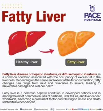 Understanding the Connection Between Belly Fat and Liver Disease