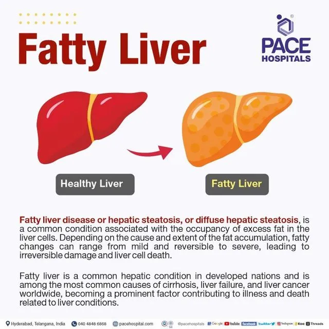 Understanding the Connection Between Belly Fat and Liver Disease